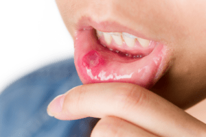 Negative Effects of Dry Mouth