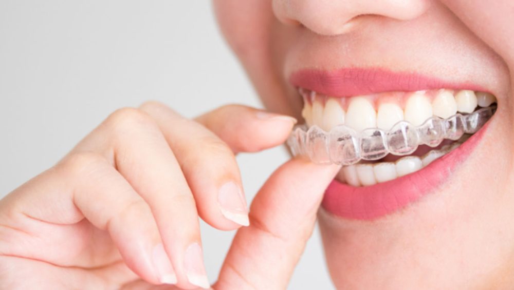 Does Invisalign Cause Dry Mouth