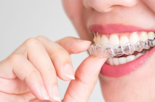 Does Invisalign Cause Dry Mouth