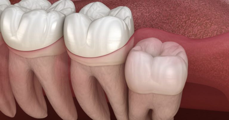 Dry Mouth After Wisdom Teeth Removal