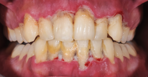 Does Gingivitis Cause Dry Mouth