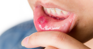 Oral Thrush