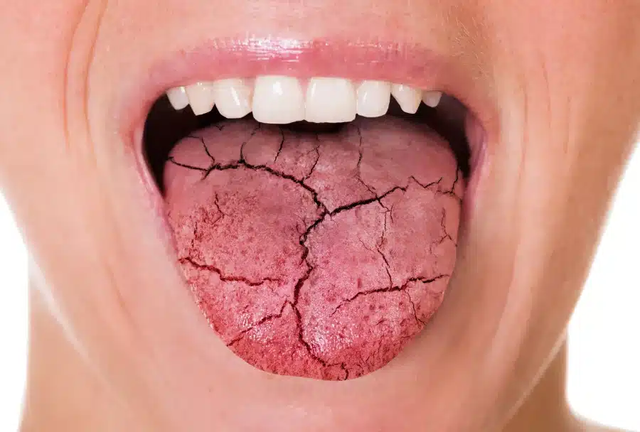 A person with their tongue sticking out, and it is cracked because of Dry Mouth a Symptom of Covid