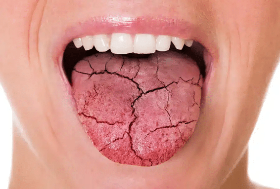 A person with a cracked tongue as a result of diabetes and dry mouth