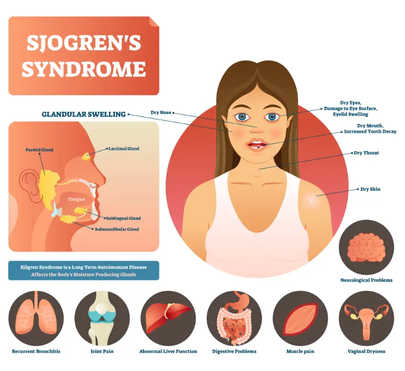 A diagram outlining the various Sjögren's syndrome symptoms people often experience