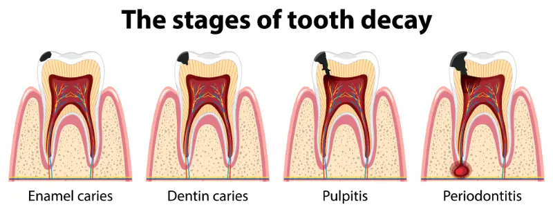 A chart outlining the progression of Periodontal Disease